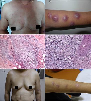 Thalidomide in the Treatment of Sweet's Syndrome and Eosinophilic <mark class="highlighted">Folliculitis</mark> Associated With Immune Reconstitution Inflammatory Syndrome